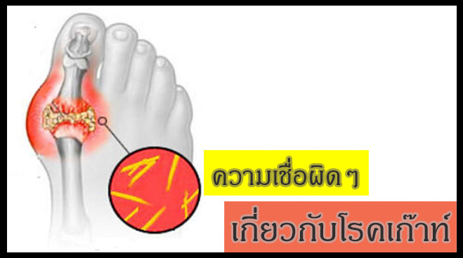เก๊าท์  หายได้ถ้ารักษาถูกวิธี
