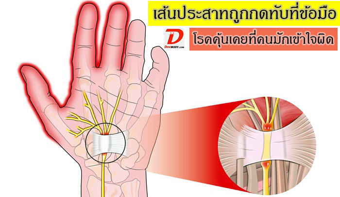 ชาปลายมือ โรคที่สับสนว่าเป็นหมอนรองกระดูกทับเส้น