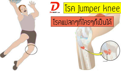 โรค Jumper knee โรคแปลกๆที่ใครๆก็เป็นได้