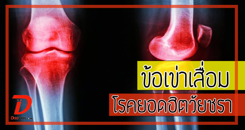 ข้อเข่าเสื่อม  โรคยอดฮิตวัยชรา