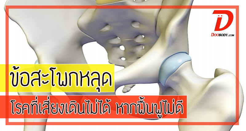 ข้อสะโพกหลุด  โรคที่จะฟื้นฟูไม่ดี  จะพาลให้เดินไม่ได้อีกตลอดชีวิต