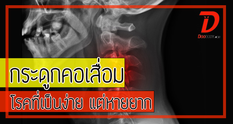 กระดูกคอเสื่อม  เป็นง่าย  แต่หายยาก