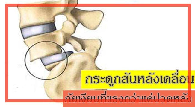 กระดูกสันหลังเคลื่อน  ภัยเงียบที่แรงกว่าแค่ปวดหลัง