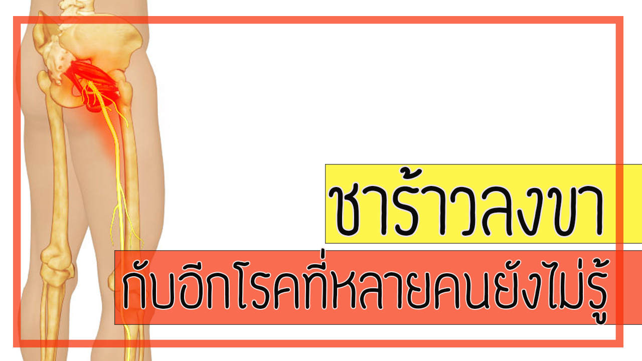 ชาร้าวลงขาหรอ  อย่าพึ่งคิดว่าเป็นหมอนรองกระดูกทับเส้น  ยังมีอีกโรคที่น้อยคนจะรู้จักที่มีอาการคล้ายกัน