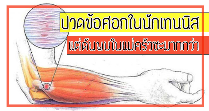 ปวดศอกในนักเทนนิส  แต่ดันพบในแม่ครัวมากกว่า