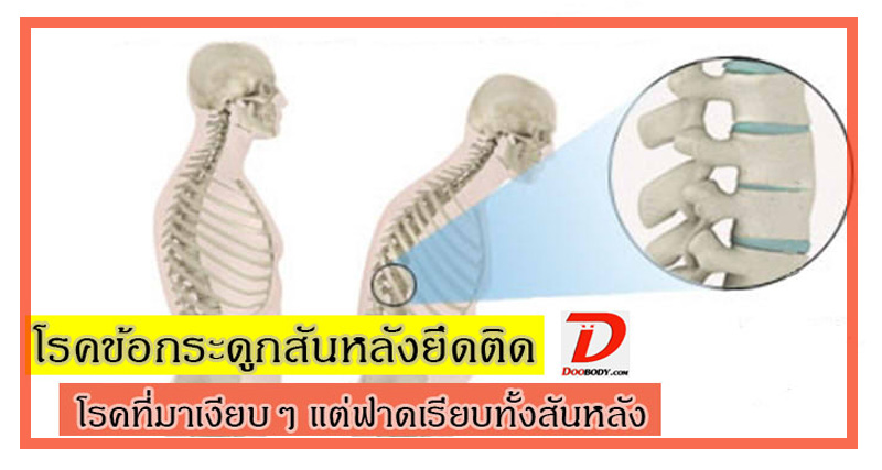  โรคข้อกระดูกสันหลังยึดติด  โรคที่มาเงียบๆ แต่ฟาดเรียบทั้งหลัง