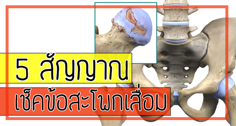 5 สัญญาณ เช็คข้อสะโพกเสื่อม (osteoarthritis of hip joint)