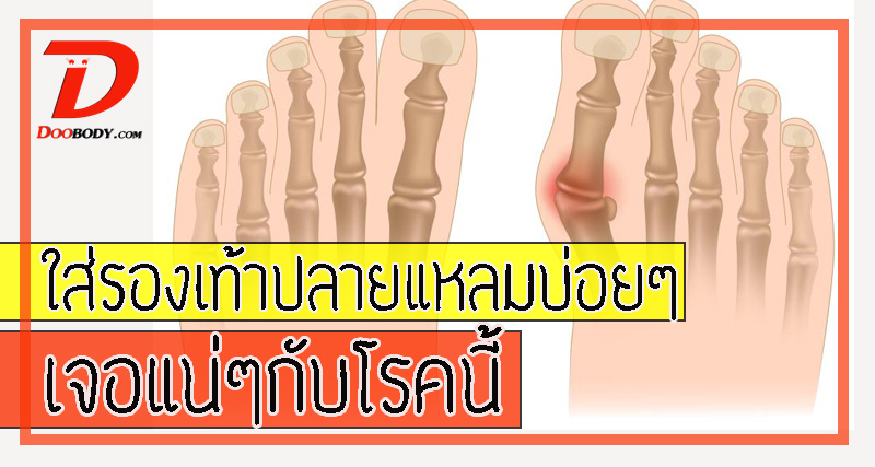 ใส่รองเท้าปลายแหลมบ่อยๆ  เจอแน่กับโรคนี้