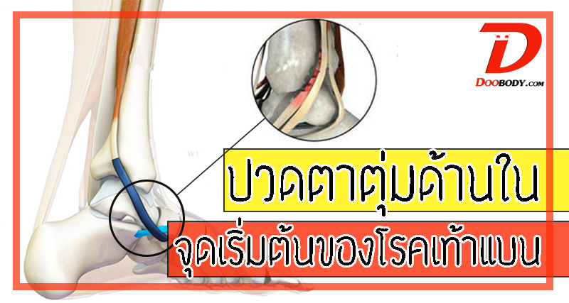 ปวดตาตุ่มด้านใน  ปวดหน้าแข้งด้านใน  กับความเสี่ยงที่ทำให้เป็นโรคเท้าแบน
