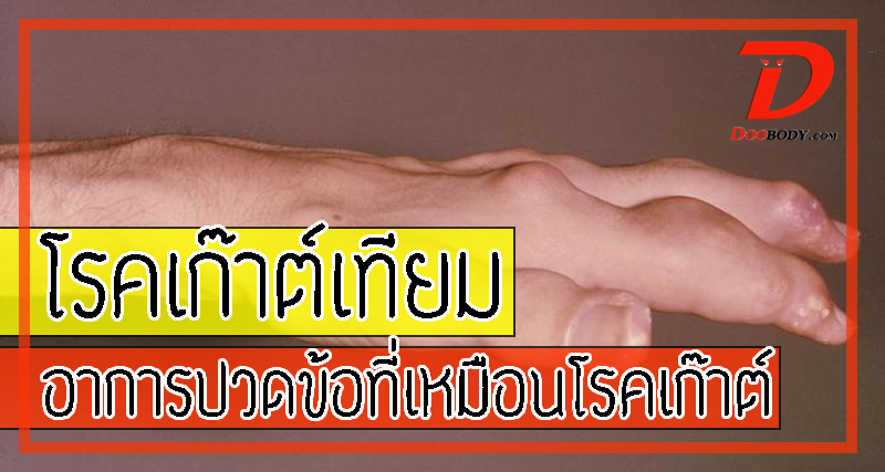 โรคเก๊าต์เทียม  (Pseudogout) โรคที่คนไข้ปวดแสบ คุณหมอปวดหัว