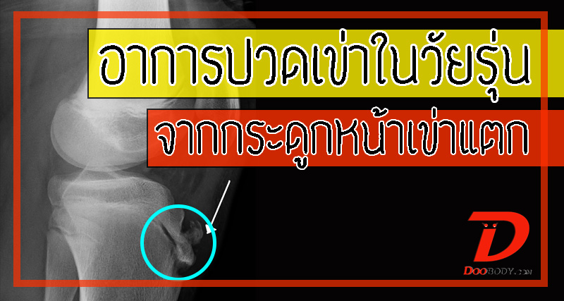 osgood schlatter  อาการปวดเข่า  เข่าปูดในวัยรุ่น  ที่ปวดจนนั่งคุกเข่าไม่ได้