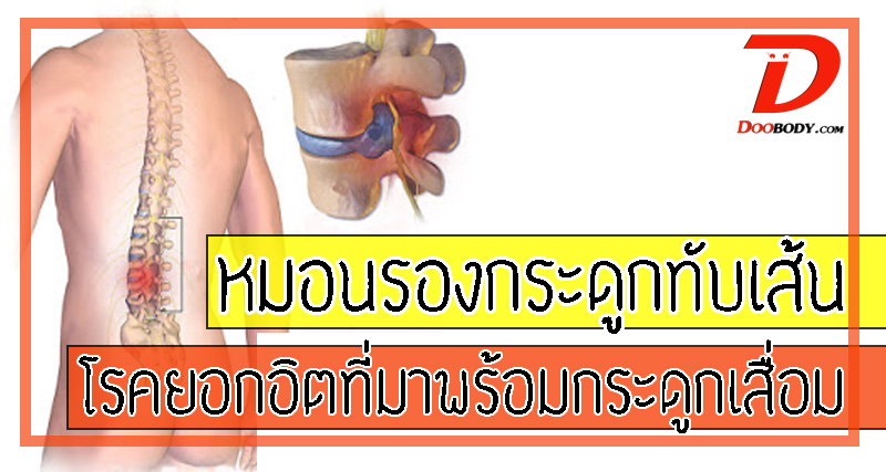 หมอนรองกระดูกทับเส้นประสาท โรคยอดฮิตที่มาพร้อมกระดูกเสื่อม