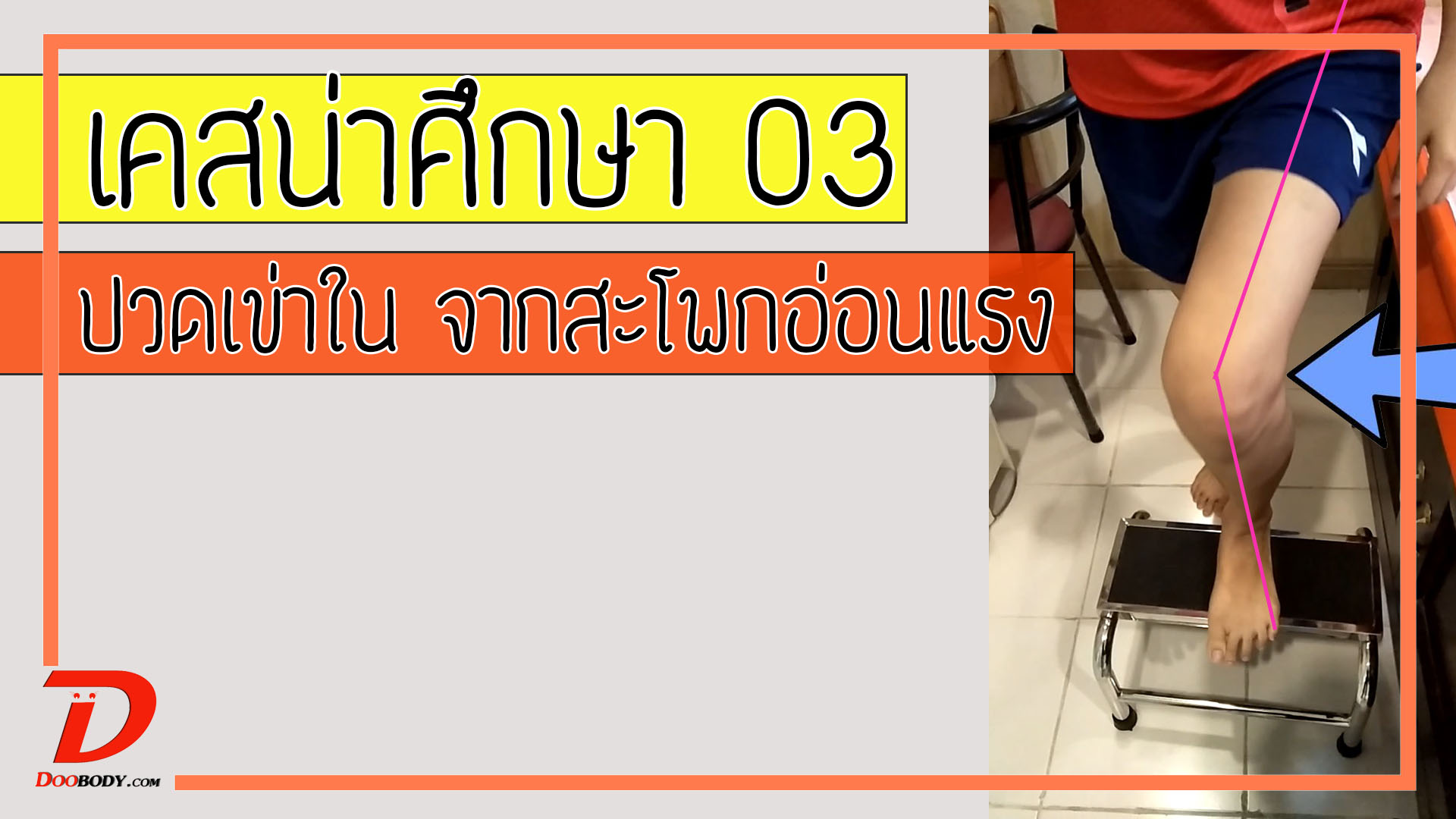เคสน่าศึกษา 03  ปวดเข่าด้านใน จากสะโพกอ่อนแรง