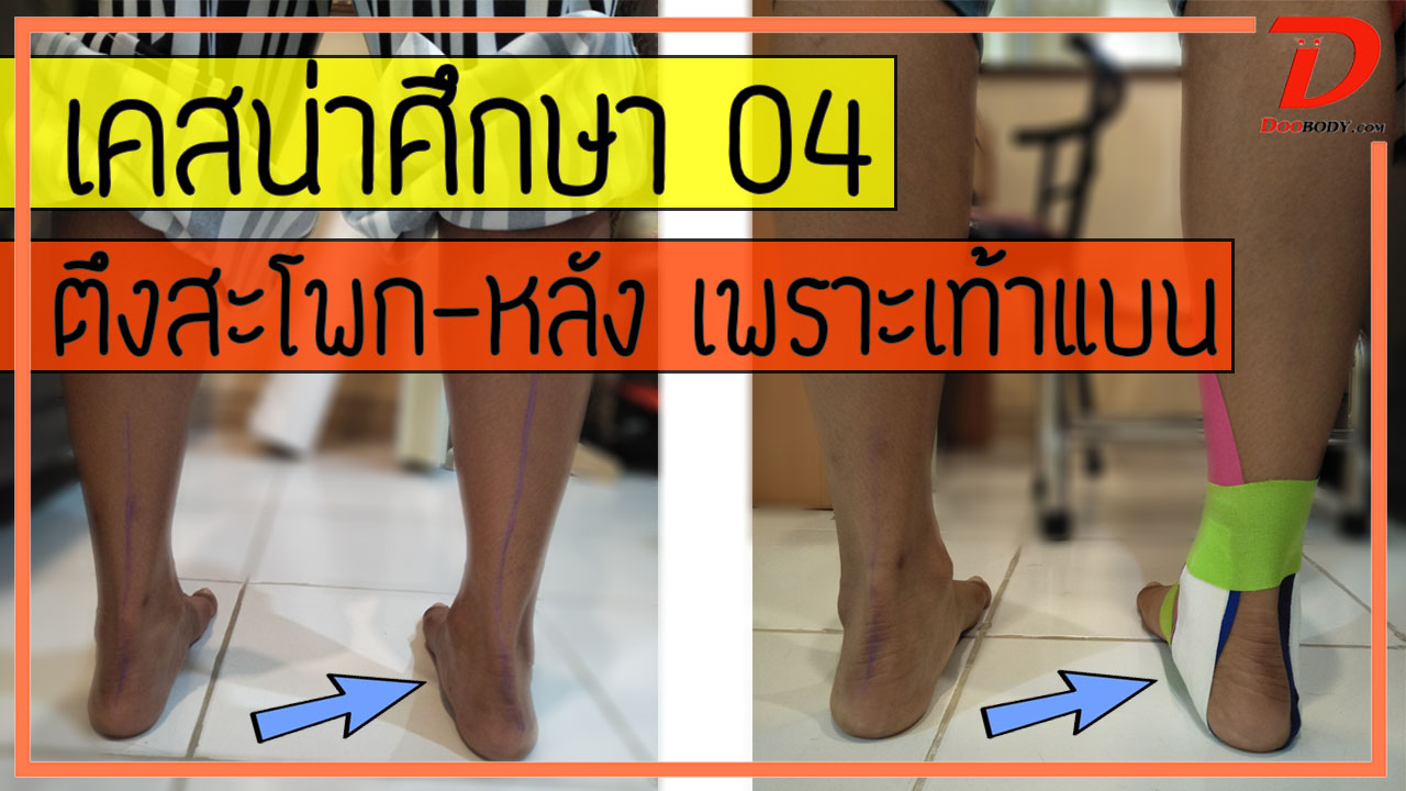เคสน่าศึกษา 04 ตึงสะโพก ปวดหลัง เพราะเท้าแบน