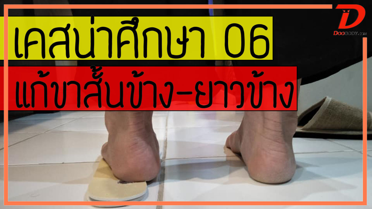 เคสน่าศึกษา 06  เปรียบเทียบแผ่นเสริมรองเท้า ในคนขาสั้นยาวไม่เท่ากัน